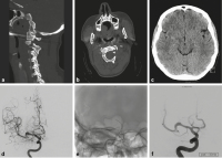 Abbildung 1a-f: Dissektionsaneurysma