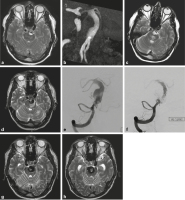Abbildung 3a-h: Arteriosklerotisches Aneurysma