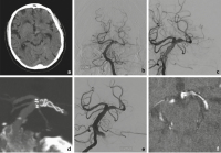Abbildung 4a-f: Arteriosklerotisches Aneurysma