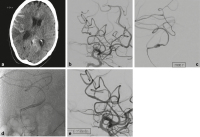Abbildung 5a-e: Mykotisches Aneurysma