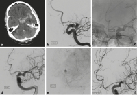 Abbildung 7a-f: Blister-Aneurysma