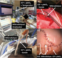 Abbildung 1A-D: Sondenimplantation