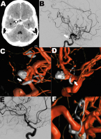 Abbildung 3: Aneurysma
