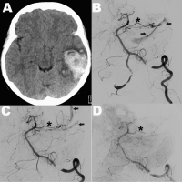 Abbildung 5: Piale arteriovenöse Fistel