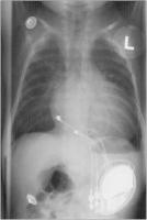 Abbildung 1: Herzschrittmacher - Kinderkardiologie