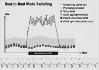 Abbildung 6: Herzschrittmacher - Vorhoftachykardie