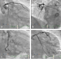 Abbildung 4a-d: Angiographie