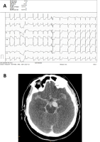 Abbildung 3: Herz-Kreislaufstillstand - Online-Abbildung 3