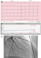Abbildung 6: Instabile Angina pectoris - Print-Abbildung 1