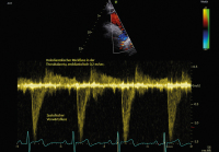 Abbildung 5: PW-Doppler