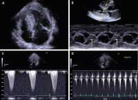 Abbildung 2: Echo - HCM