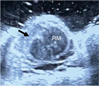 Abbildung 2: Intraoperative Sonographie