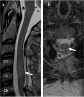Abbildung 4a-b: Postoperatives MRT