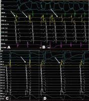 Abbildung 2: HRA-Katheter -  His-Katheter - CS-Katheter - RVA-Katheter