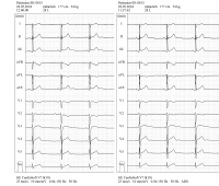 Abbildung 2: High-Pass-Filter