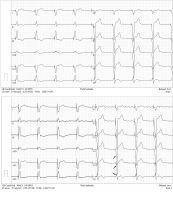 Abbildung 3: Low-Pass-Filterung