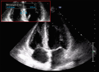 Abbildung 1: Echokardiographie