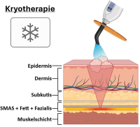 Abbildung 3: Kryotherapie