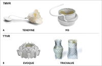 Abbildung 1A-B: Mitralklappenersatz