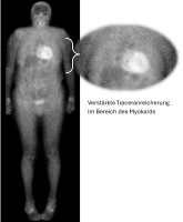 Abbildung 2: Szintigraphie