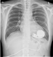 Abbildung 1: Thoraxröntgen