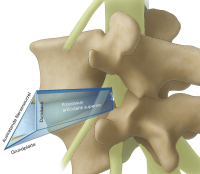 Abbildung 1: Kambin-Dreieck