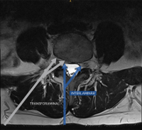 Abbildung 5: Zugangstrajektorie