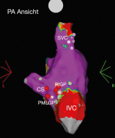 Abbildung 2: Elektroanatomisches Voltage-Mapping