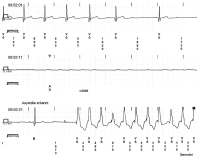 Abbildung 3: AV-Block