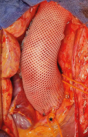 Abbildung 5: Aortic-PEARS