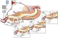 Abbildung 4: Crawford-Operation