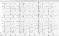Abbildung 1: EKG