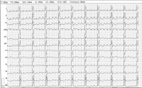 Abbildung 2: EKG
