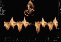 Abbildung 1: Fall 1: LVOT-Gradient
