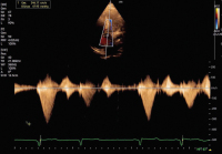 Abbildung 2: Fall 1: LVOT-Gradient