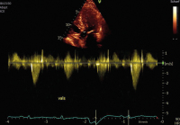 Abbildung 5: Fall 3: LVOT-Gradient