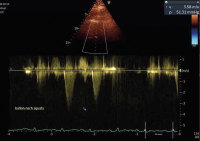 Abbildung 6: Fall 3: LVOT-Gradient