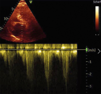 Abbildung 9: Fall 4: LVOT-Gradient