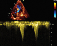 Abbildung 10: Fall 4: LVOT-Gradient