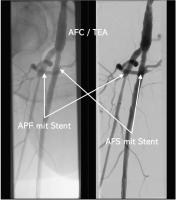 Abbildung 6: Kissing-Stent