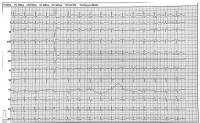 Abbildung 1: EKG