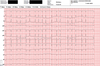 Abbildung 1: EKG