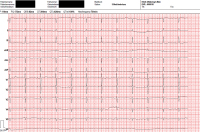 Abbildung 2: EKG