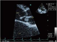 Abbildung 1: Aortenklappeninsuffizienz - Endokarditis