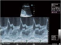 Abbildung 2: Aortenklappeninsuffizienz - Endokarditis