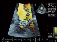 Abbildung 3: Aortenklappeninsuffizienz - Endokarditis