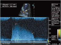Abbildung 4: Aortenklappeninsuffizienz - Endokarditis
