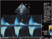 Abbildung 5: Aortenklappeninsuffizienz - Endokarditis