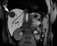 Abbildung 1: Echinokokkus - Leber