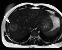 Abbildung 2: Echinokokkus - Leber